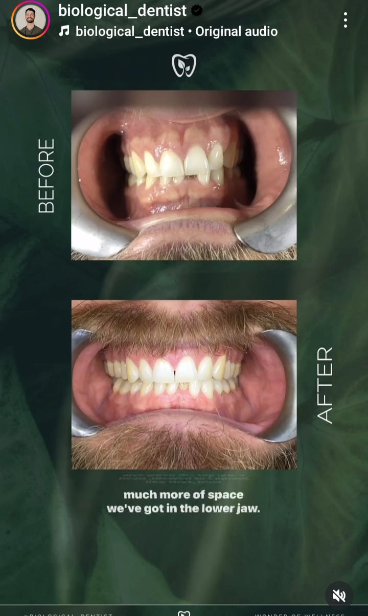 Snapshot of an Instagram story by biological_dentist where he has shared before and after pictures of his treatment